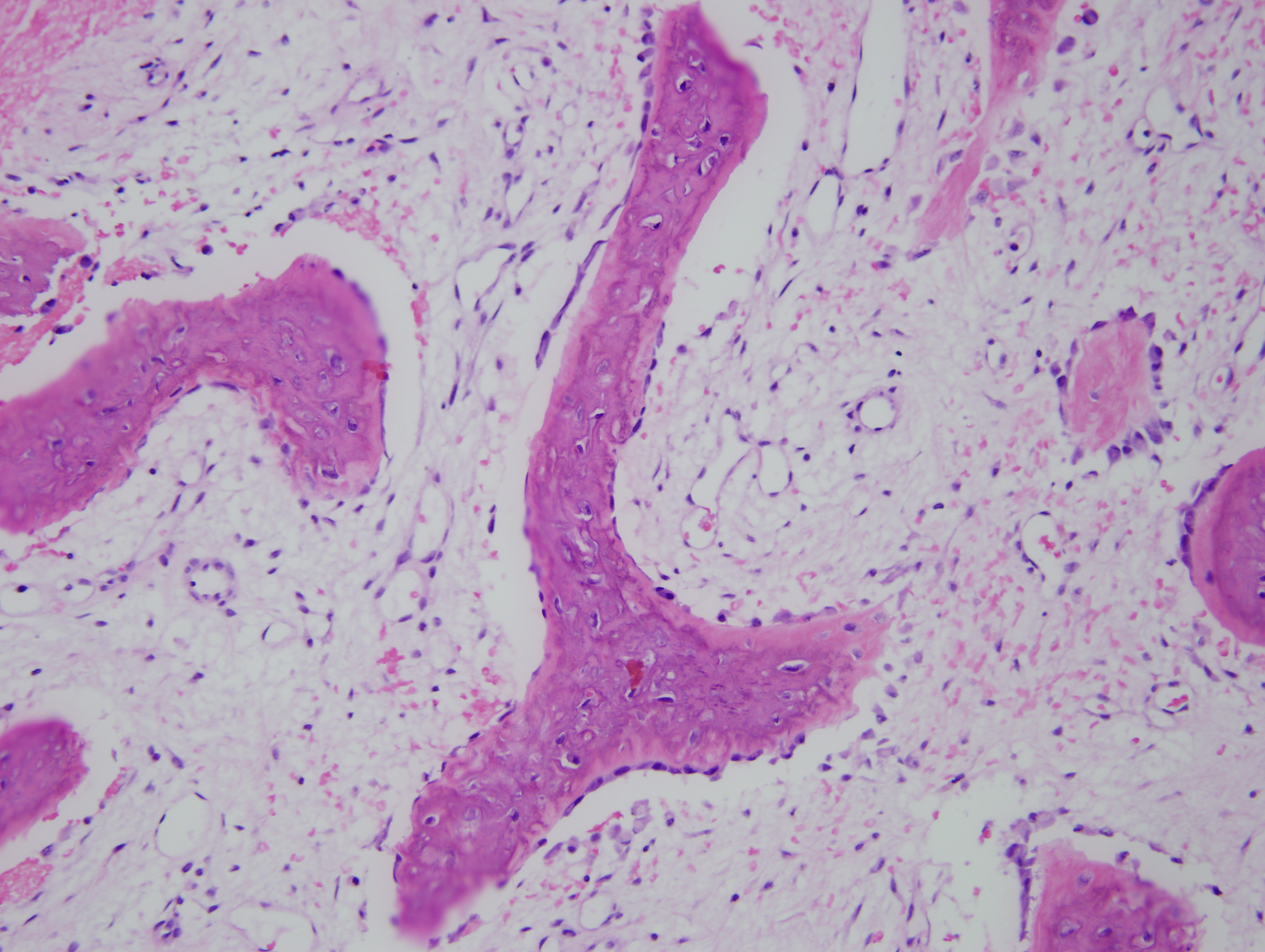 a-pathological-fracture-in-a-10-year-old-boy-bonetumor